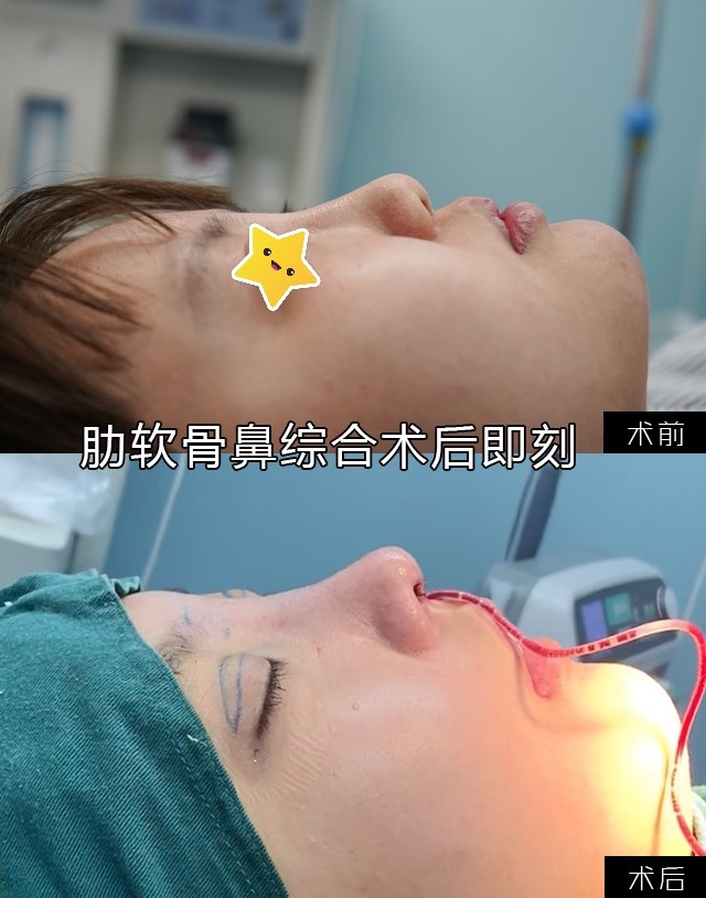鼻整形赵新峰案例