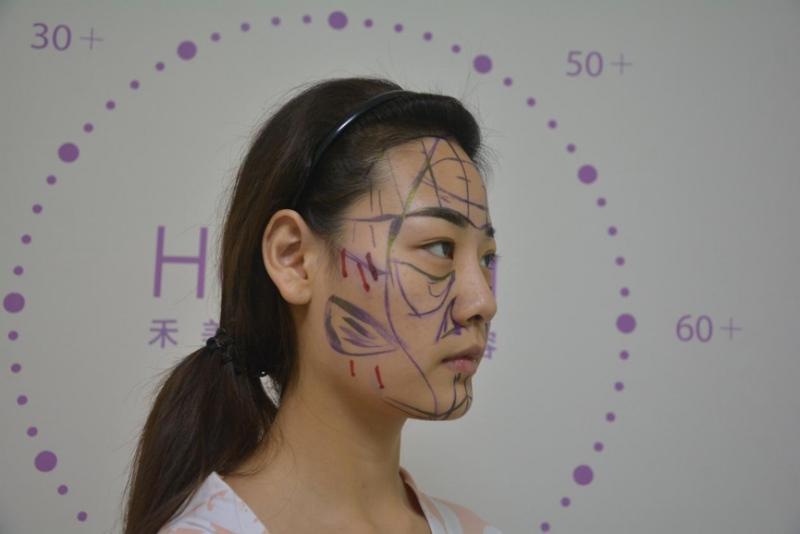 自体脂肪面部填充术前画线