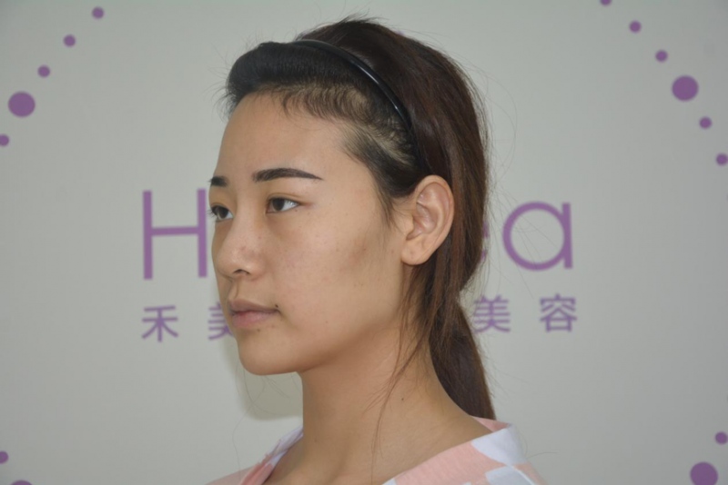 自体脂肪面部填充术前侧面照
