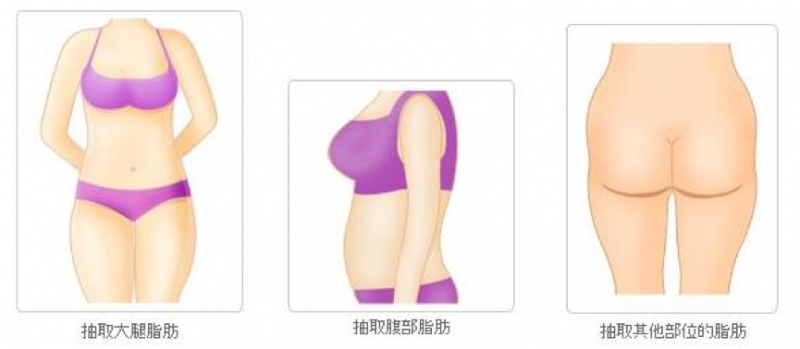 可以从不同部位抽取脂肪
