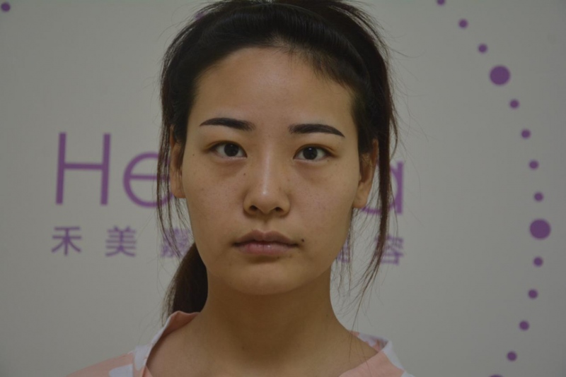 自体脂肪面部填充术前正面照