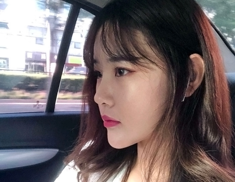 自体脂肪面部填充术后恢复20天